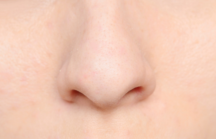 鼻先が丸い人にBNLS・脂肪溶解注射